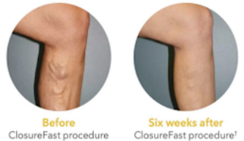 ClosureFast procedure vein treatment