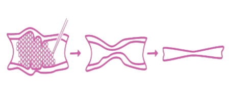 Varithena vein treatment