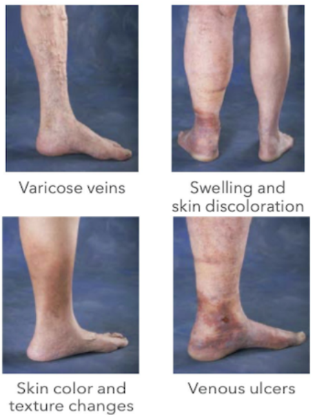 Varicose veins illustration
