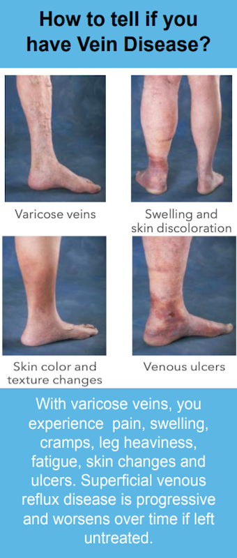 Cheap Vein Disease Treatment in Florida